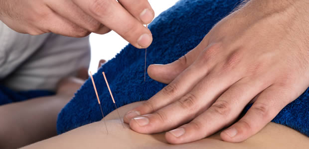 Acupuncture Sevenoaks with needles placed in the back of a woman image